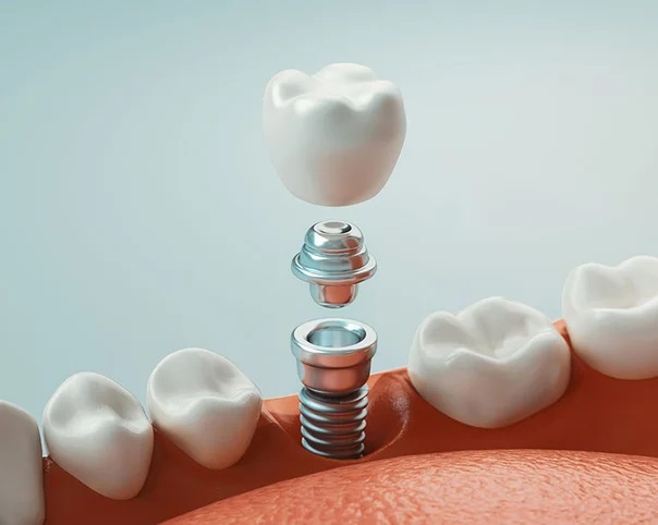 implants