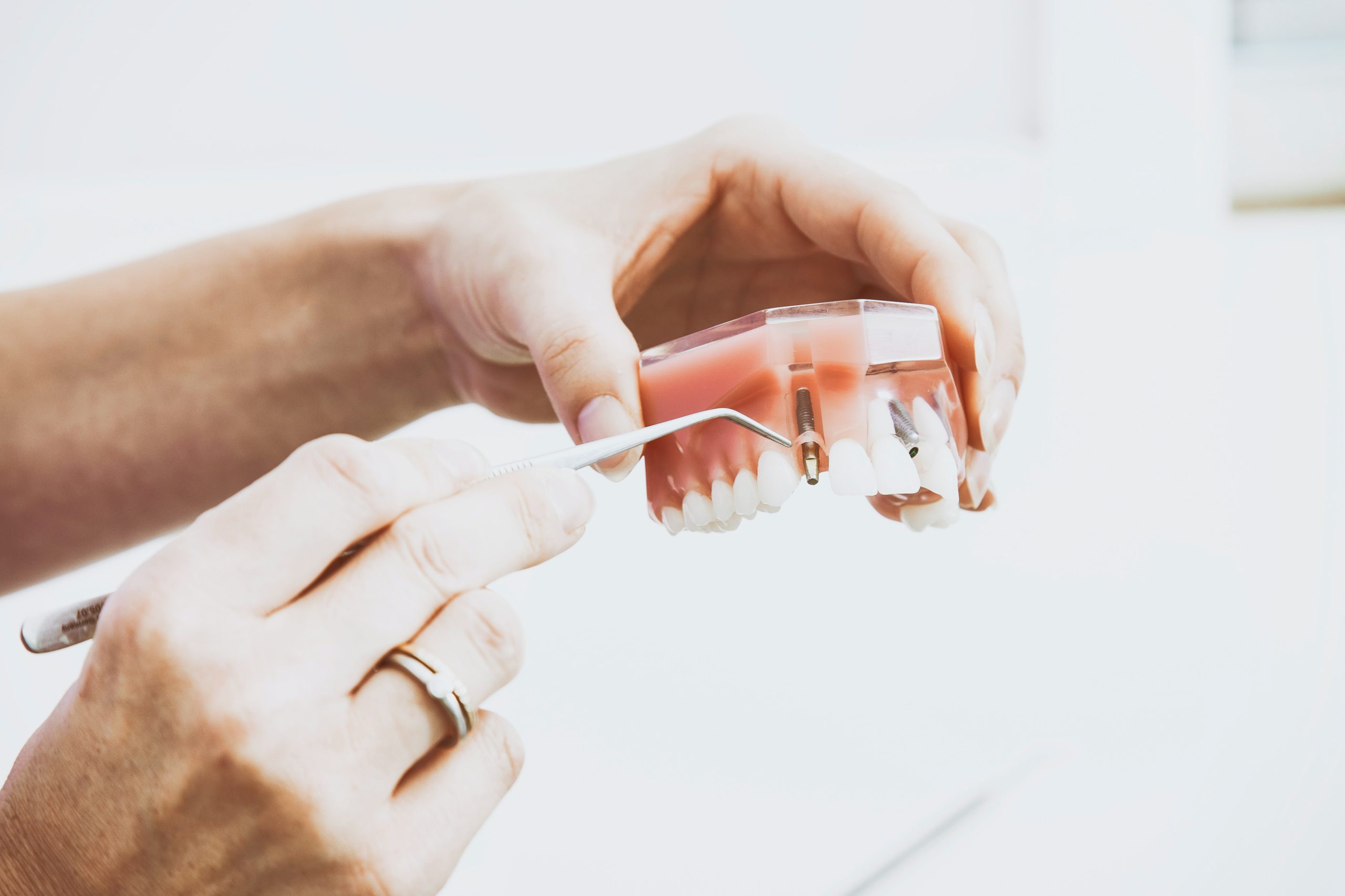 How To Get Help With Dental Implants