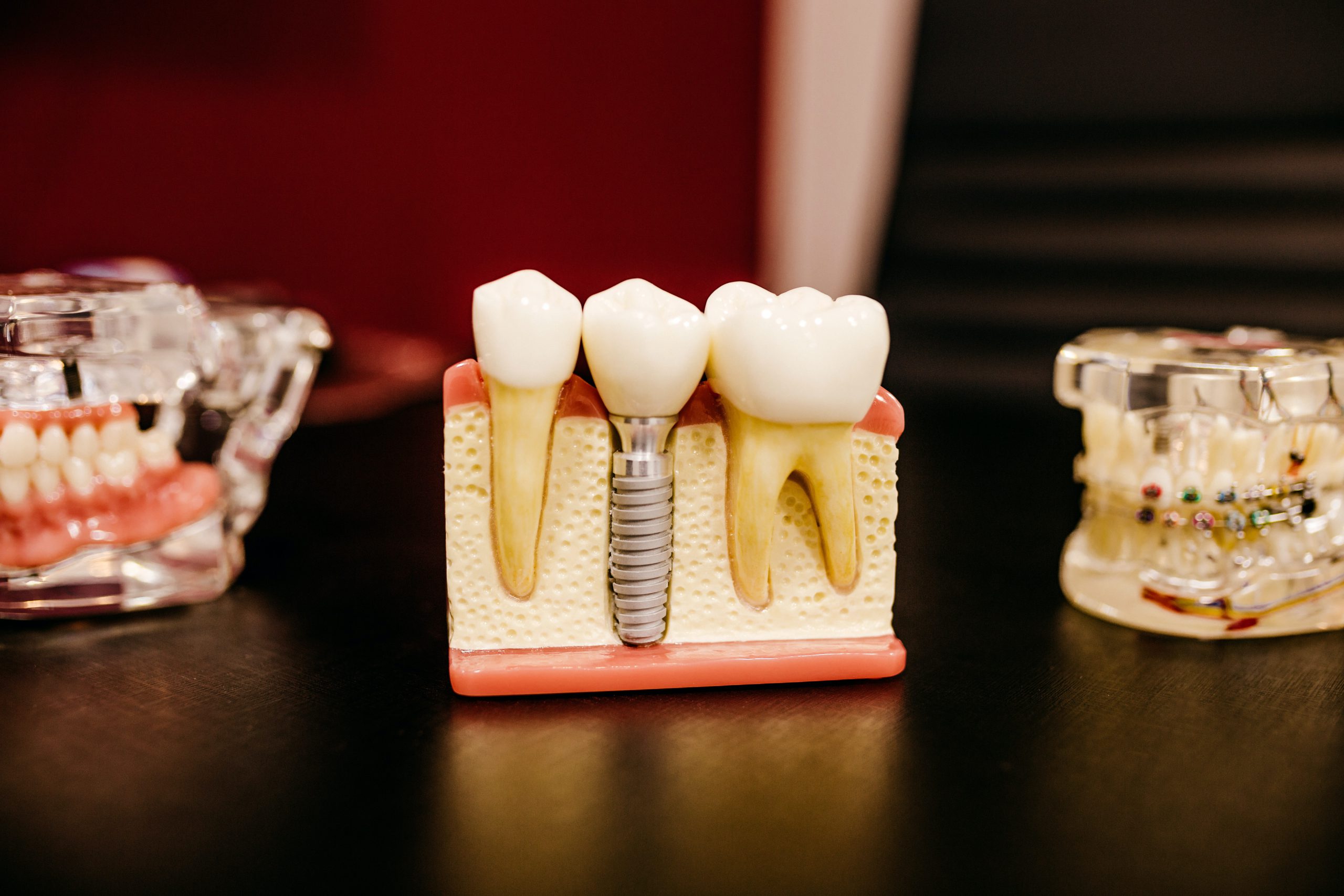 Dental Implants & Self Esteem