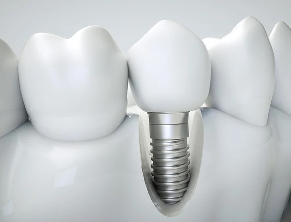 missing-tooth
