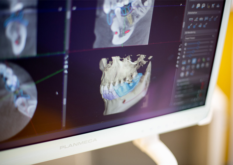 The Benefits Of Multiple Dental Implants