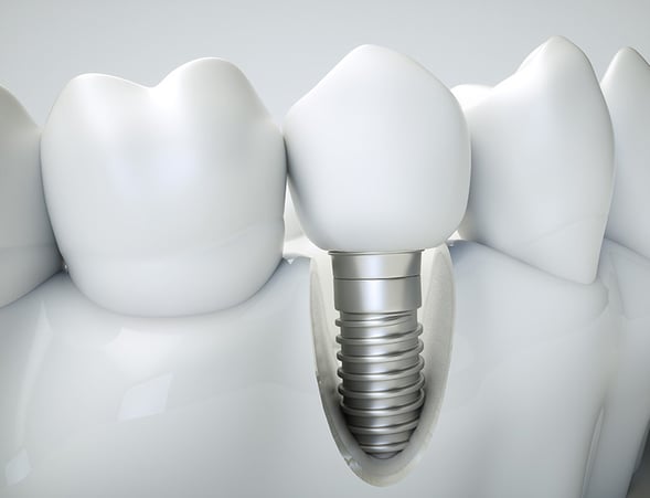 image_implant