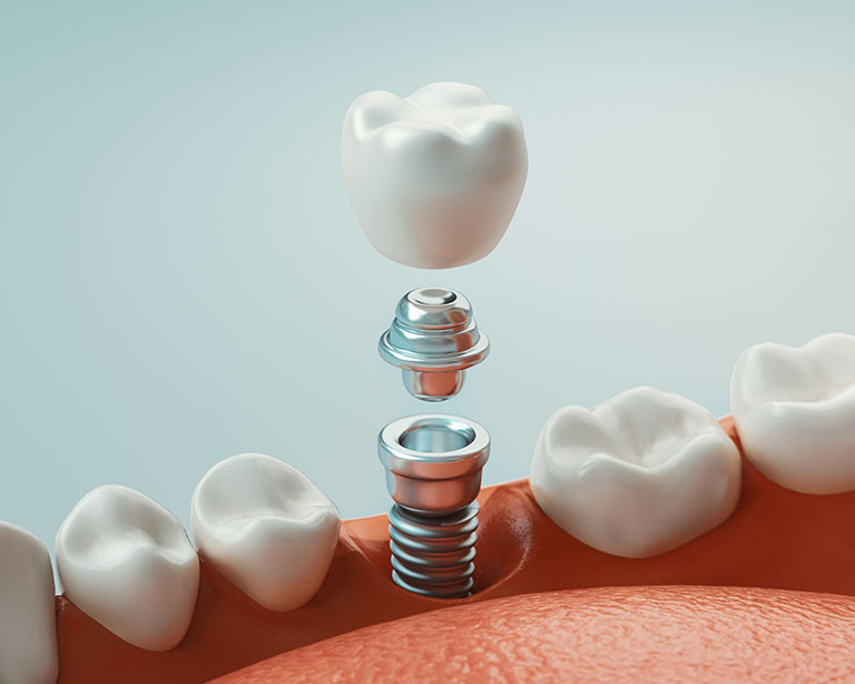 Dental implant graphic