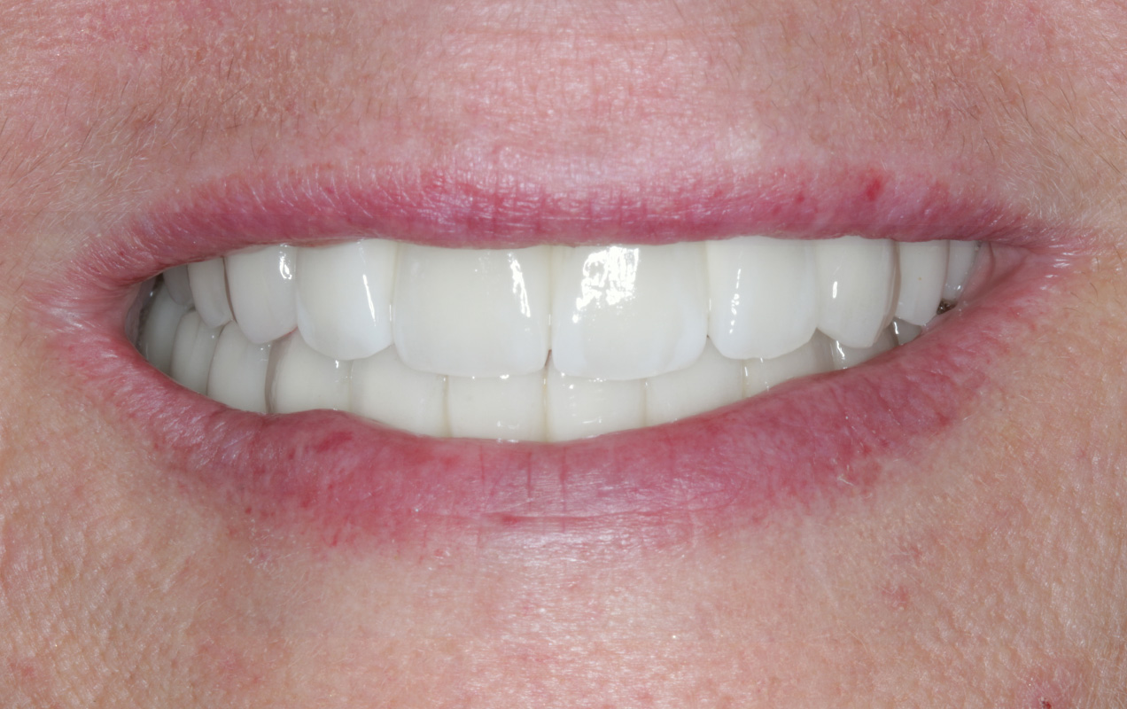 The Affects Of Gum Disease