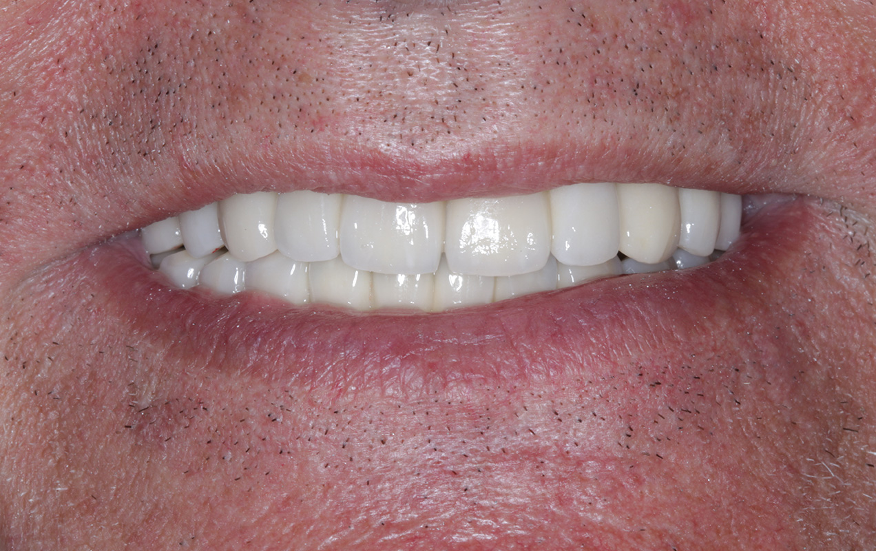 Loss Of Teeth Affecting Your Smile