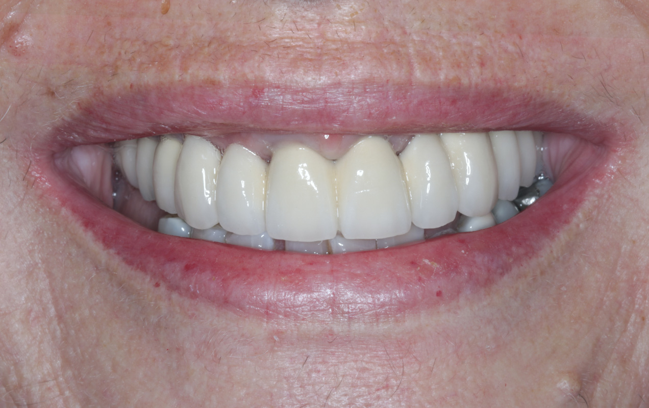 Multiple Dental Treatments