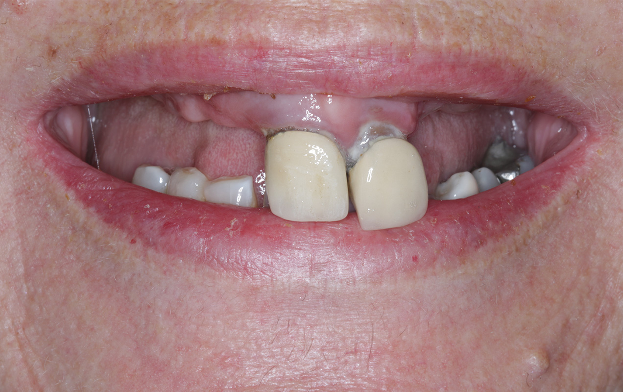 Before